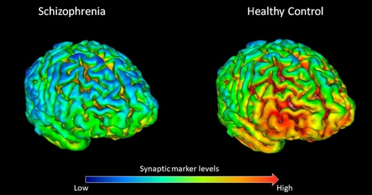 Шизофренія як еволюційна плата за великий мозок? - Сергій Клемін на we.ua