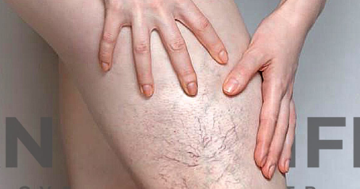 Варикозне розширення вен - що потрібно для вирішення проблеми - PREMIUM на we.ua