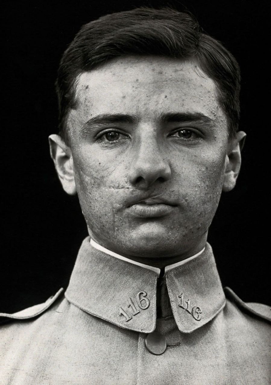 Французький солдат, поранений в обличчя в 1918 році