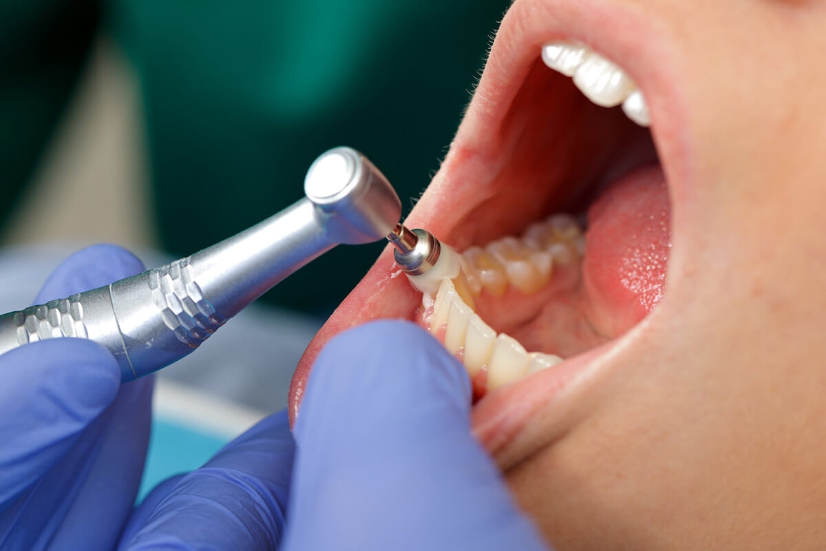 Dental Treatment For Loose Teeth | Dental Practice in Columbia MD