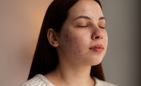 Acne Treatment in Dubai | Acne Scar Laser Treatment in Dubai