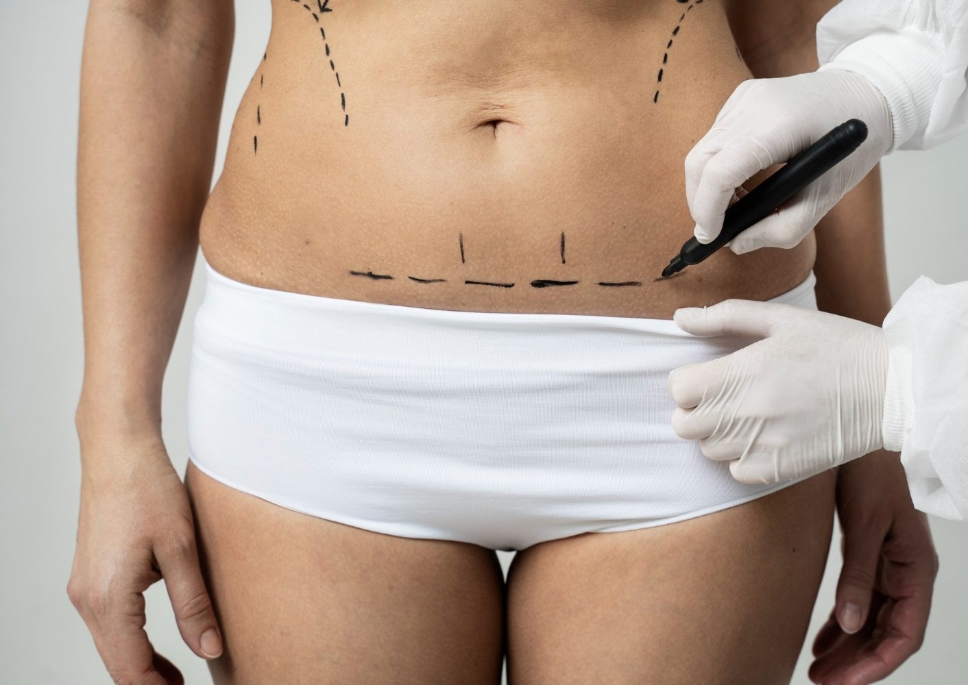 Everything Need To Know About Tummy Tuck Dubai