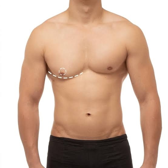Gynecomastia Dubai - Male Breast Reduction | Dr Kotti